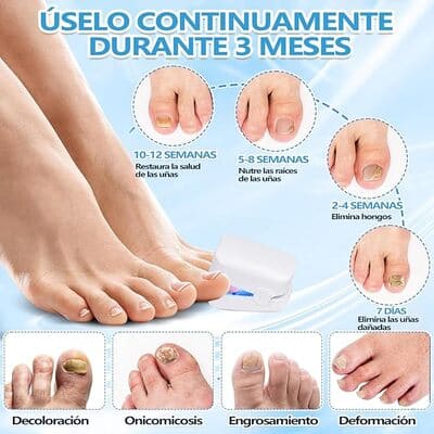 Laser De Hongos Para Uñas