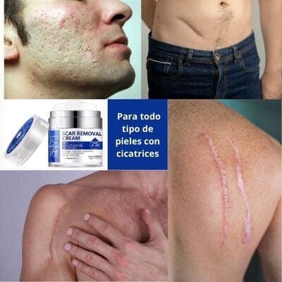 Crema Para Cicatrices